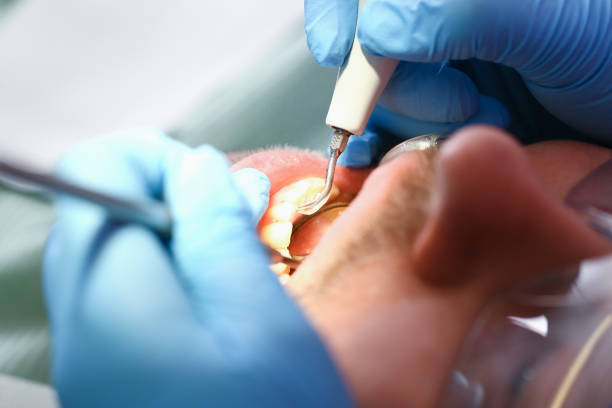 Best Knocked-Out Tooth (Avulsed Tooth) Treatment in Alba, NY